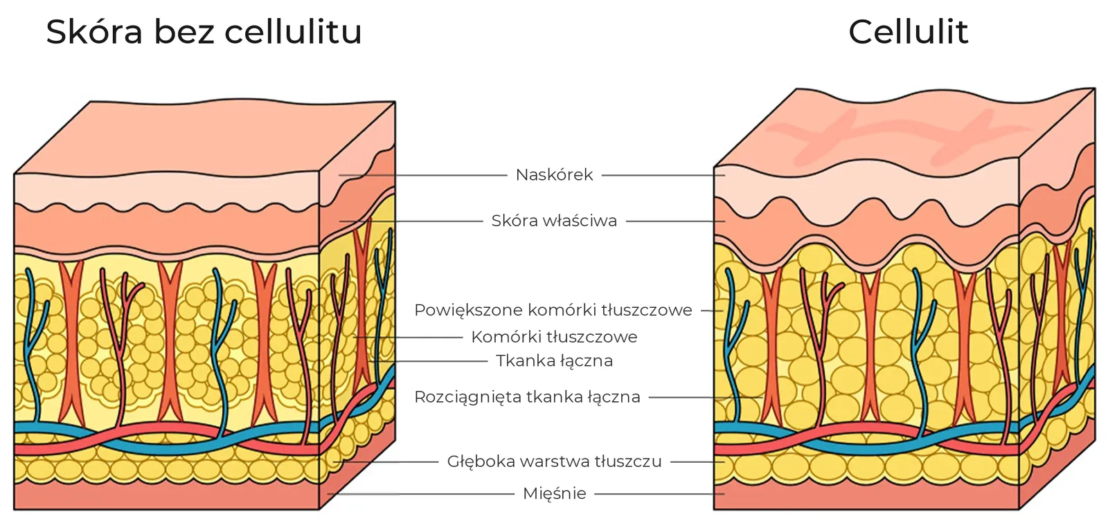 Schemat przekroju skóry bez cellulitu i z cellulitem: naskórek, skóra właściwa, powiększone komórki tłuszczowe, tkanka łączna, głęboka warstwa tłuszczu i mięśnie