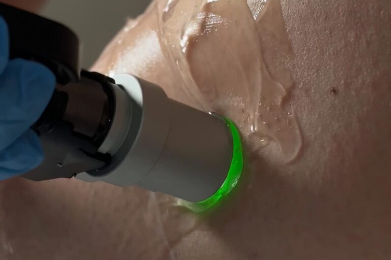 Głowica Moveo lasera Motus PRO na skórze z żelem