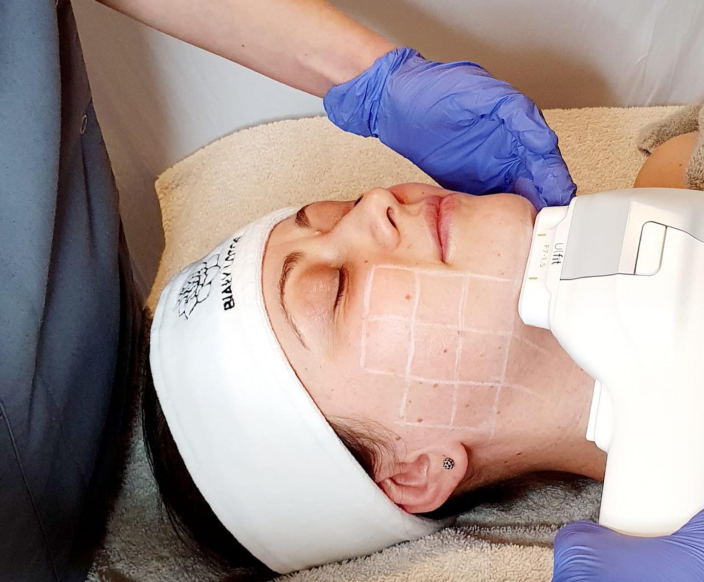 Zabieg HIFU Ulfit na twarz w salonie Biały Lotos we Wrocławiu: głowica na policzku, na skórze narysowana siatka zabiegowa