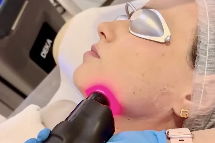 Zabieg laserem RedTouch PRO na linię żuchwy w salonie Biały Lotos we Wrocławiu
